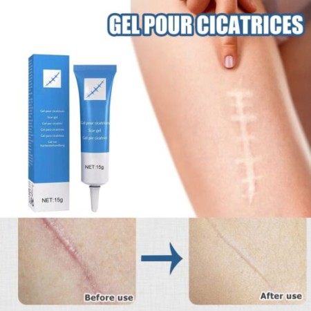 Eelhoe Pores Remover Scar Removal Stretch Marks Relief And Burns Acne Mark Removal
